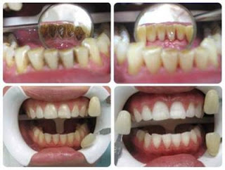 Професійна гігієна зубів