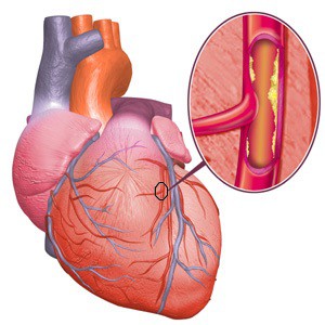 Ішемічна хвороба серця (ІХС)