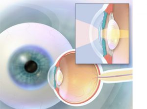 операція заміна кришталика ока