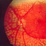Діабетична ретинопатія
